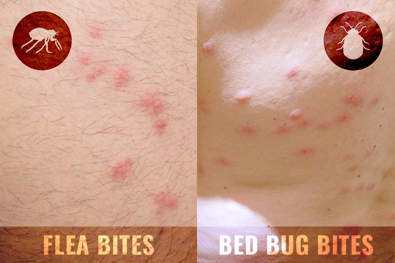What’s The Difference Between Flea Bites And Bedbug Bites?